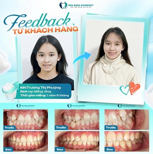 Hành trình lột xác nụ cười sau khi niềng răng của KH Đỗ Xuân Hào