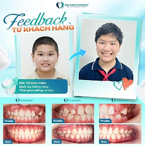 Hiệu quả niềng răng sớm sau 3 năm – màn lột xác ấn tượng của khách hàng Võ Đức Kiên (2012)