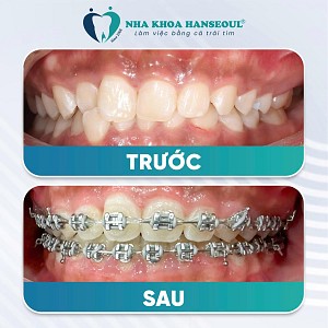 KH Trần Yến Nhi thay đổi ngoạn mục sau gần 2 năm niềng răng mắc cài