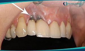 Hối hận khi trồng Implant giá rẻ – Nguy cơ tiềm ẩn về bệnh răng miệng