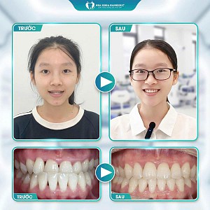 Khách hàng Nguyễn Thu Duyên niềng răng công nghệ BIOSMART