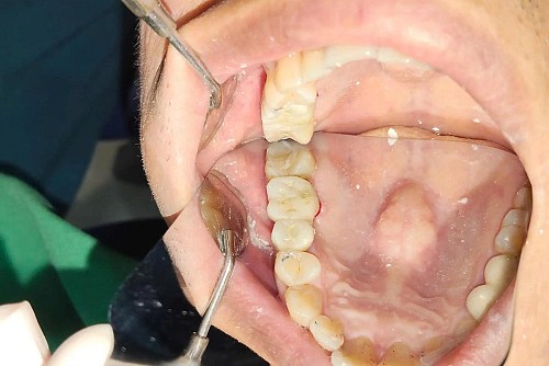 hoan-thanh-cay-ghep-implant-–-phuc-hoi-rang-mat-vung-chac-cho-anh-vu-xuan-quang thumbnail