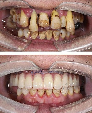 “Ở tuổi 68, tôi chỉ mong ăn được bữa cơm ngon…” – Hành trình tìm lại răng đã mất của cô Lê Thị Lan tại Hanseoul