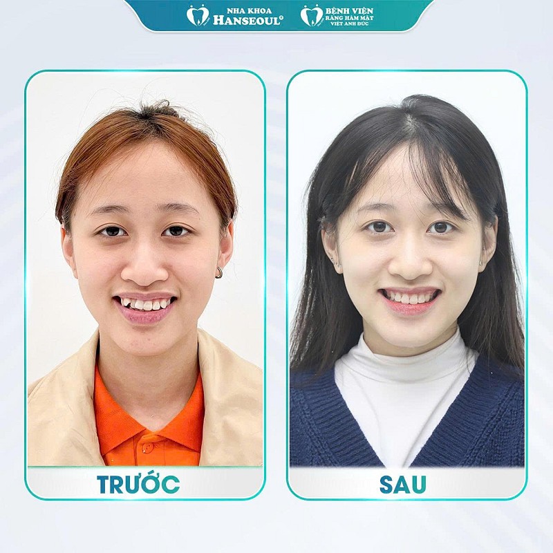 Top 3 Ca niềng răng khó thay đổi ngoạn mục tại Nha khoa Hanseoul - Bệnh viện RHM Việt Anh Đức Top 3 Ca niềng răng khó thay đổi ngoạn mục tại Nha khoa Hanseoul - Bệnh viện RHM Việt Anh Đức