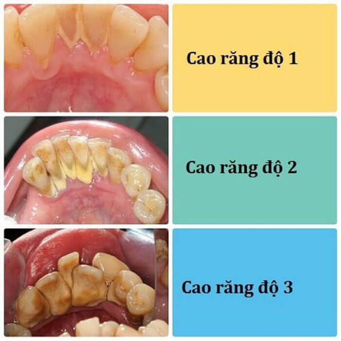 3-cap-do-cua-cao-rang 3-cap-do-cua-cao-rang