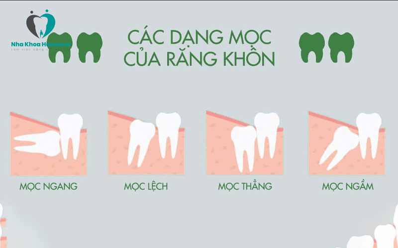 Các loại răng khôn