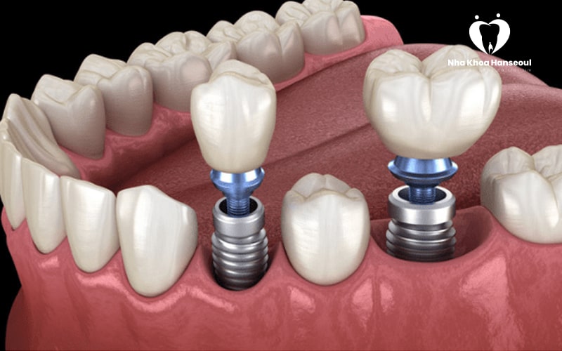 Phục hình bằng trồng răng Implant