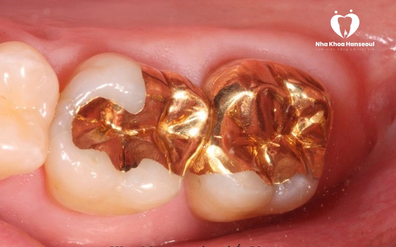 Trám răng bằng chất liệu kim loại quý tại Nha Khoa Hanseoul