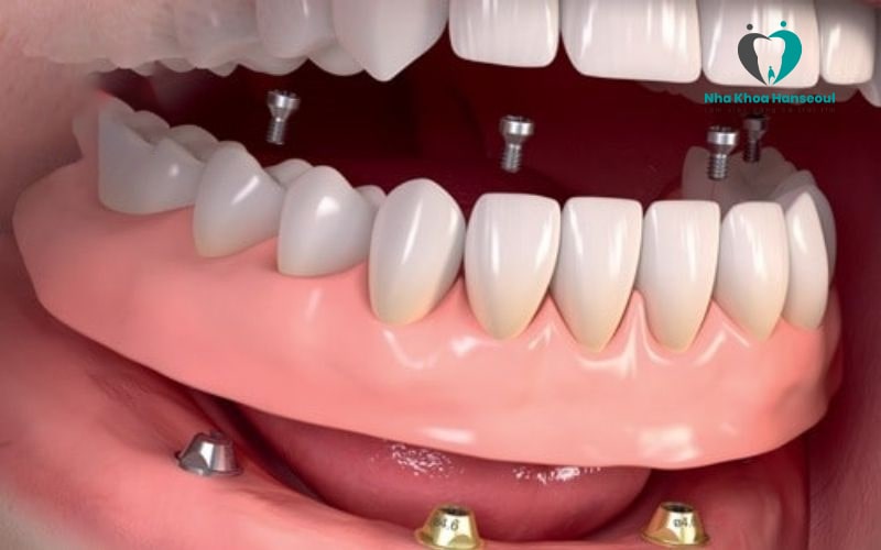 Trồng răng Implant all on 4