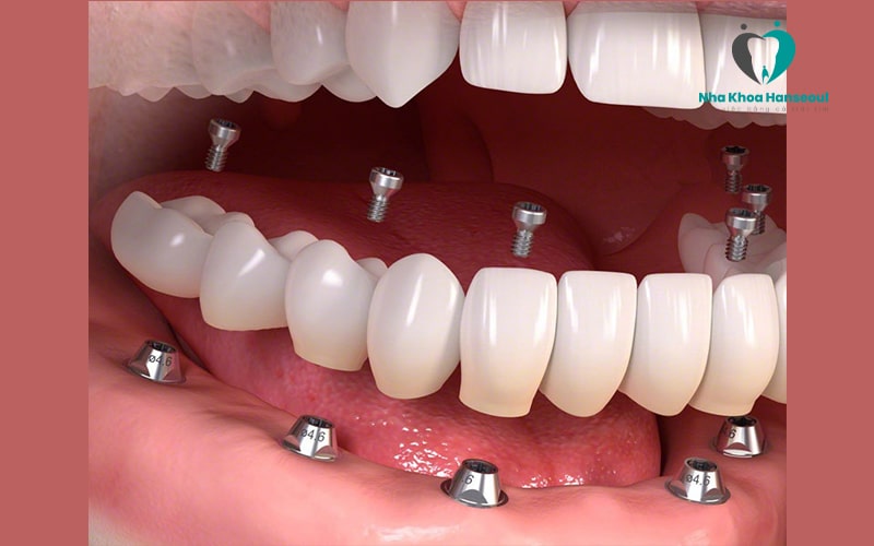 Trồng răng implant all on 6