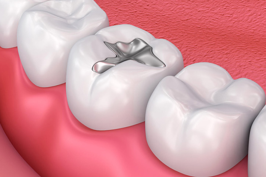 Trám răng bằng chất liệu Amalgam