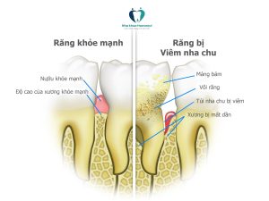 bệnh viêm nha chu là bệnh răng miệng thường gặp