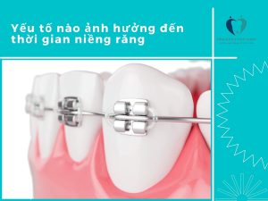 yếu tố nào ảnh hưởng đến quá trình niềng răng?