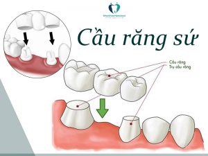 phục hình răng với phương pháp cố định