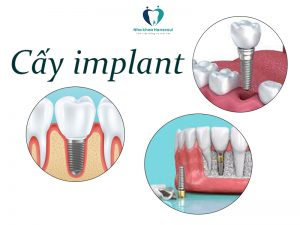 phục hình răng bằng cấy implant