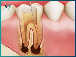 áp xe là bệnh răng miệng thường gặp