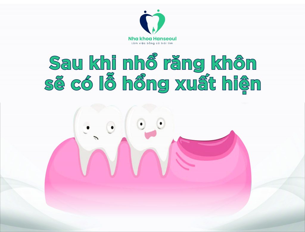 au khi nhổ răng khôn sẽ có lỗ hổng xuất hiện