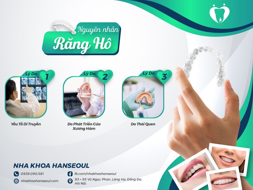 răng hô ảnh hưởng đến khả năng ăn nhai và tính thẩm mỹ