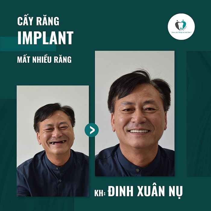 Benh nhan sau khi trong implant 1