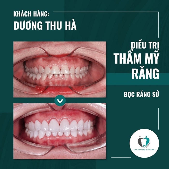 Bệnh nhân bọc răng sứ tại nha khoa Hanseoul
