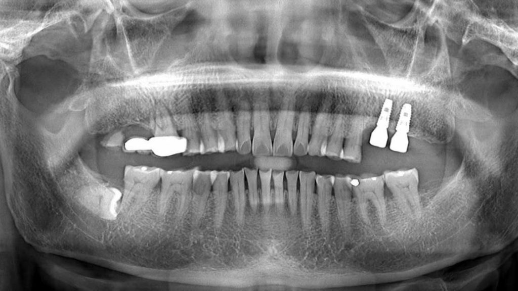 Chụp CT trồng răng implant