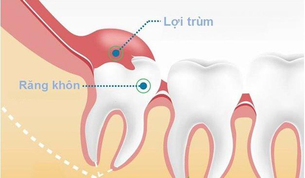 Đau nhức khi mọc răng khôn