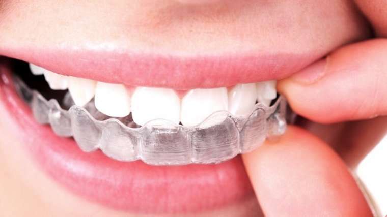 Đeo máng tẩy trắng răng