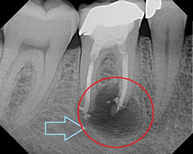 Điều trị tủy bọc răng sứ