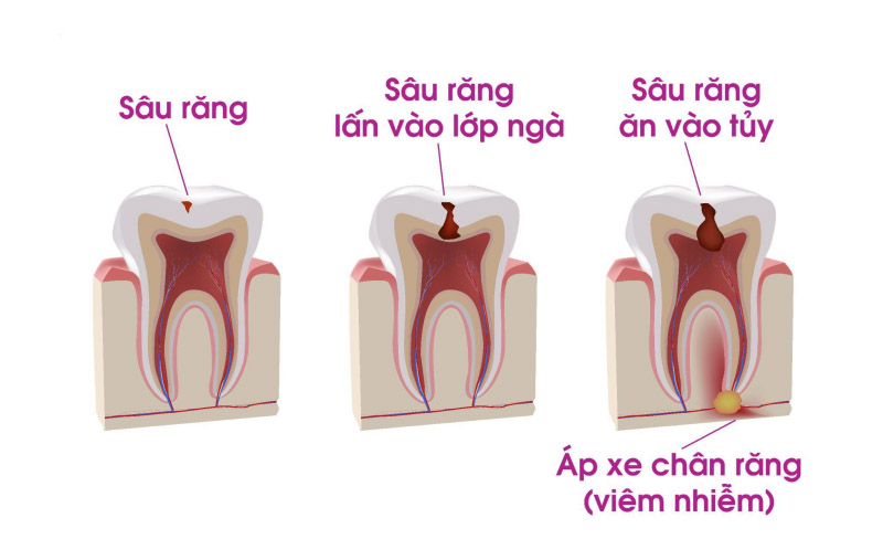 Điều trị tủy