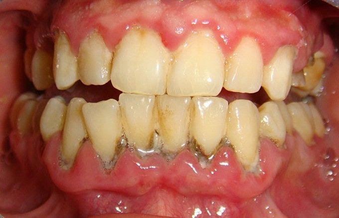 Độ dày cao răng