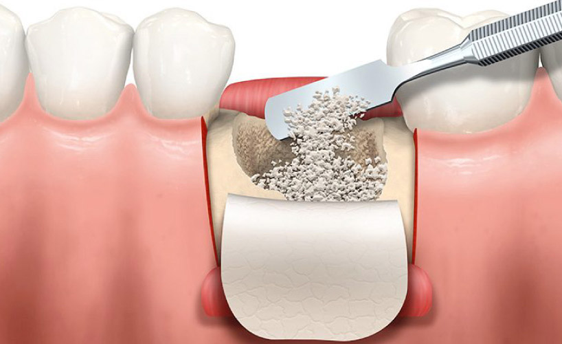 Ghép xương răng 6