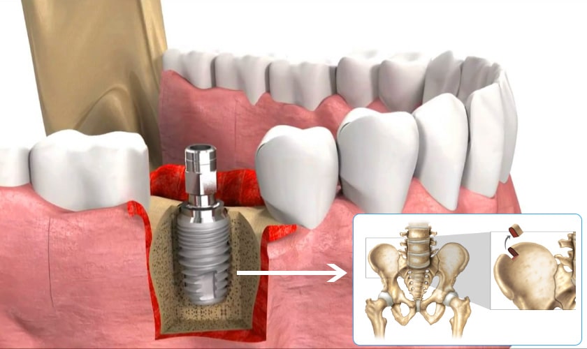 Ghép xương răng 4