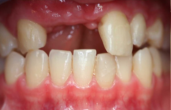 Mất răng cửa không nên trám răng