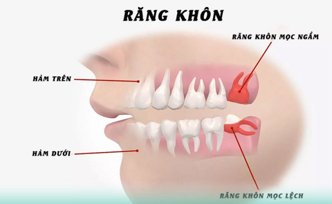 Nhổ răng khôn nên ăn gì