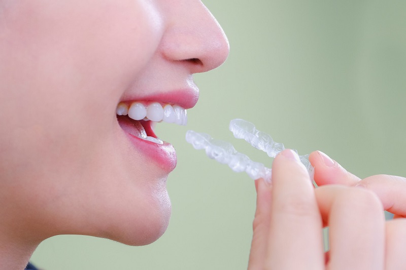 Niềng răng Invisalign