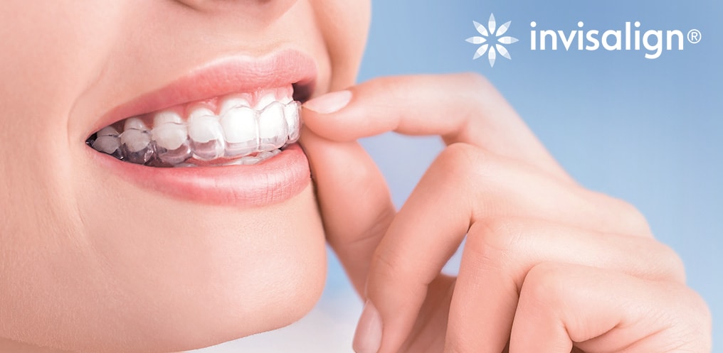 Niềng răng invisalign