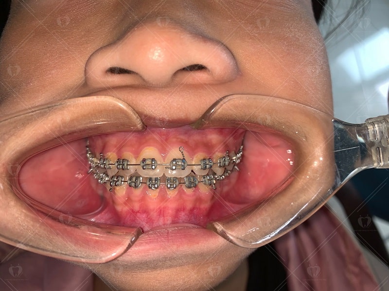 Niềng răng tại nha khoa Hansoeul