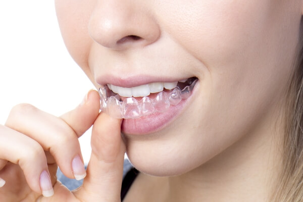niềng răng trong suốt Invisalign
