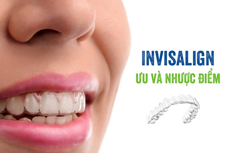 Niềng răng trong suốt invisalign