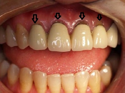 Răng đen viền nướu sau khi bọc răng sứ