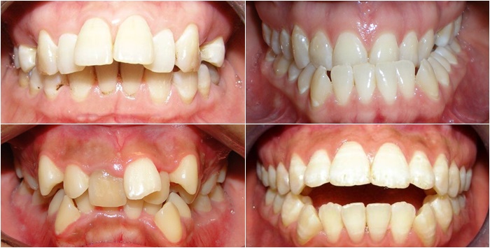 Các trường hợp răng không nên trám răng
