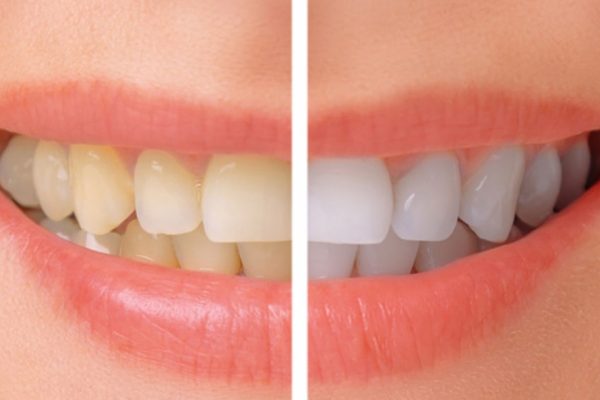 Tẩy trắng răng mặt ngoài