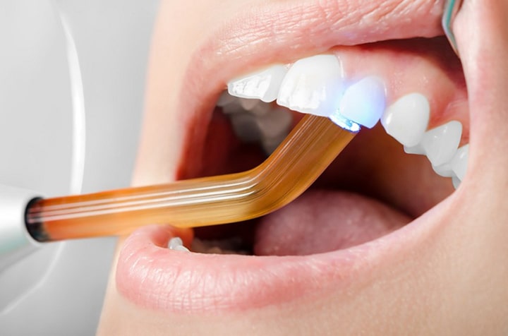 Trám răng thẩm mỹ cho bệnh nhân