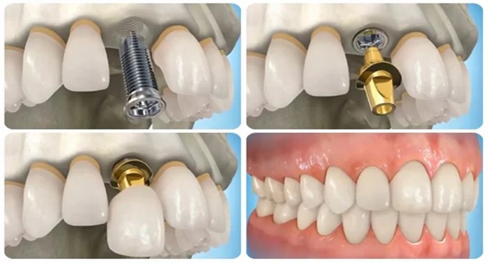 trồng răng implant so với các trồng răng giả truyền thống