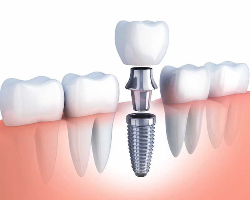 Trụ răng Implant