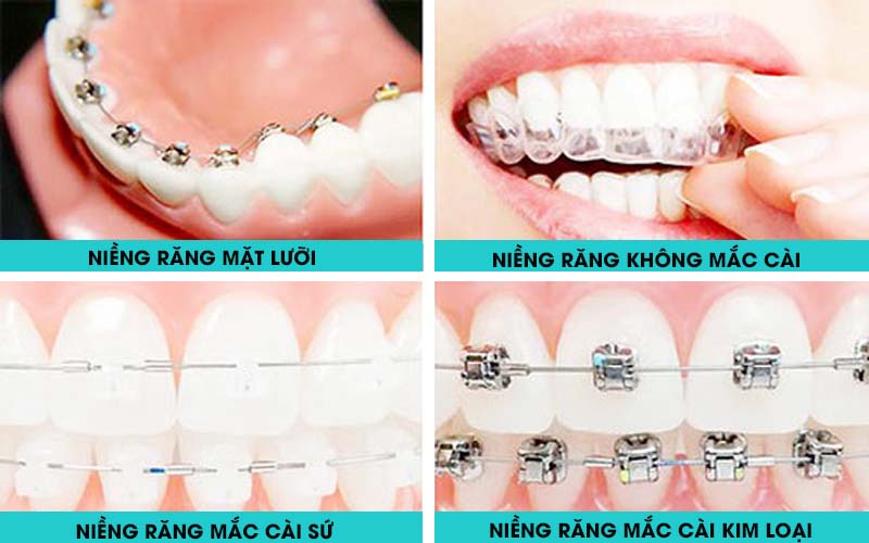 Các loại niềng răng phổ biến