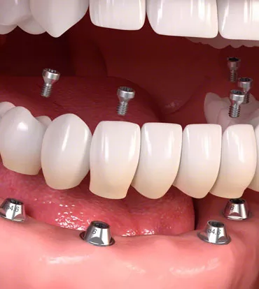 làm răng implant ở đâu tốt nhất hà nội