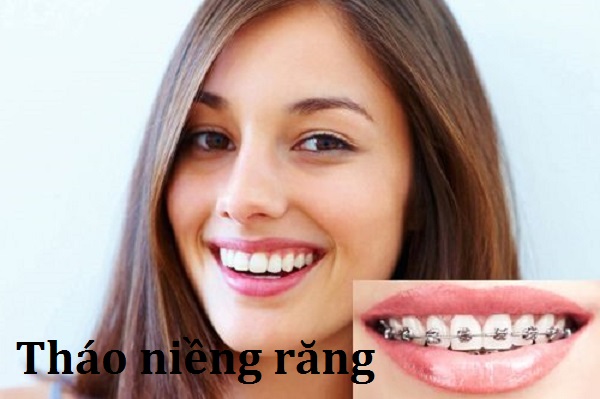 Bao lâu được tháo niềng răng