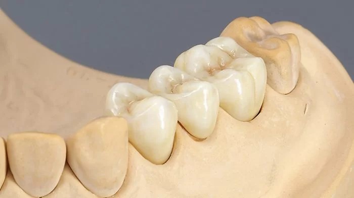 Bọc răng sứ cho răng vỡ mẻ
