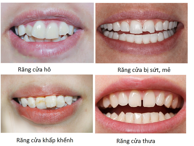 Các trường hợp bọc răng sứ